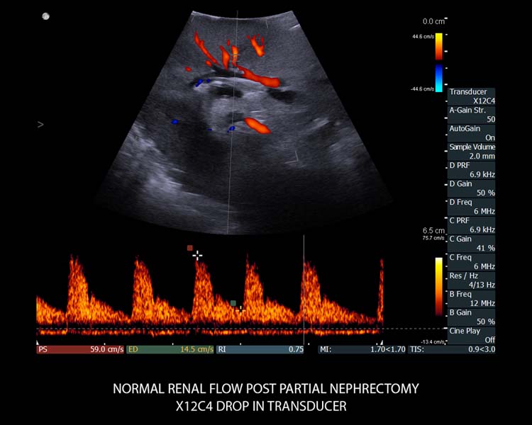 Normaler Nierenfluss nach partieller Nephrektomie